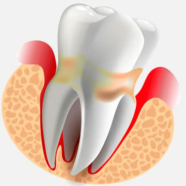 Diş Eti Şişmesi Neden Olur Ne İyi Gelir