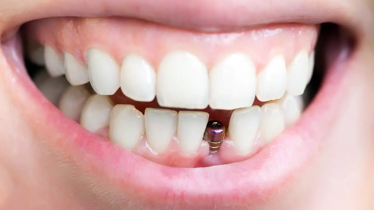 Ankara İmplant Tavsiye | İmplant Yaptırmadan Önce Bilmeniz Gerekenler