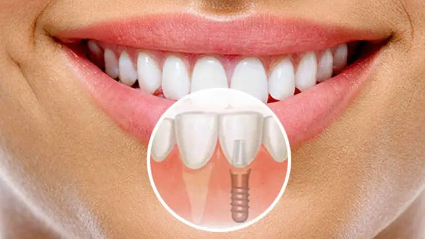 Ankara 1 diş implant fiyatları 1 diş implant fiyatı, tek diş implant fiyatları