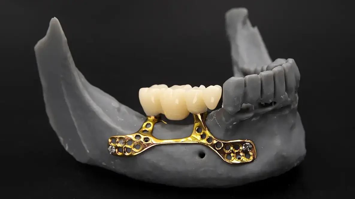 Subperiostal implant 3D modeli - kemik üstü implant yerleşimi