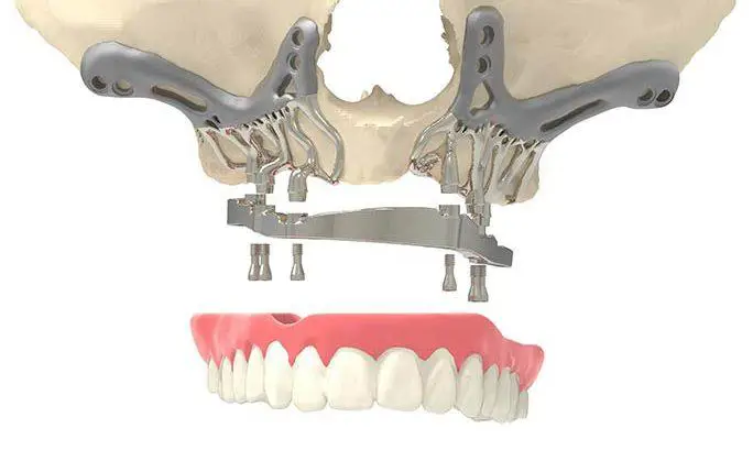 Subperiostal implant sonrası sabit protez görünümü - kemik yetersiziliğinde çene protezi uygulaması