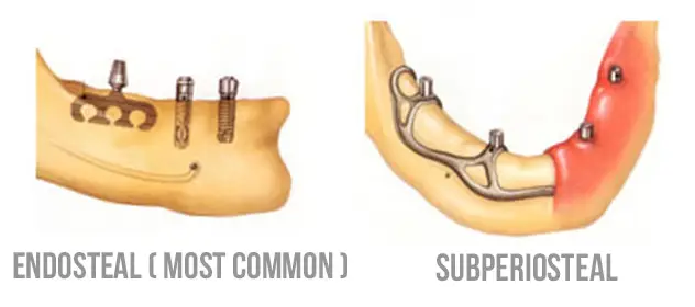 Subperiostal implant uygulama aşamaları - Endoteal İmplant Nedir?